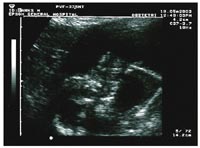 Ultrasound